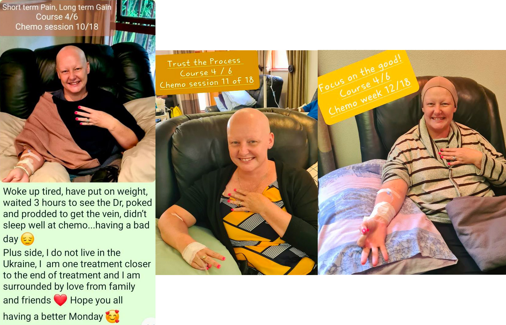 Chemotherapy Course 4 – March 2022